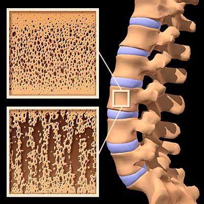 Нарушение структуры костной ткани при остеопорозе